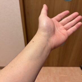 手の骨折ユーザー必見！100均で買える超絶便利グッズ